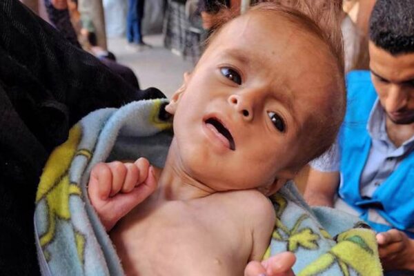 La hambruna impuesta por Israel mata a otros dos niños palestinos en Gaza